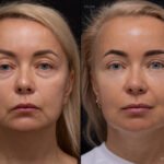 блефаропластика