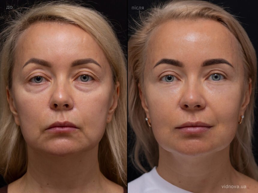 блефаропластика